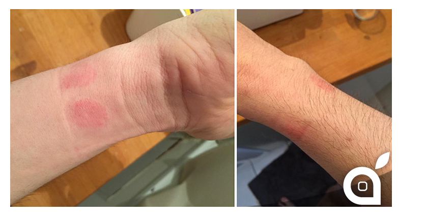 Apple Watch: Träger klagen über Hautirritationen – Hartware